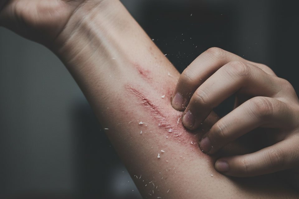 Hipnoz ve Ürtiker Kurdeşen